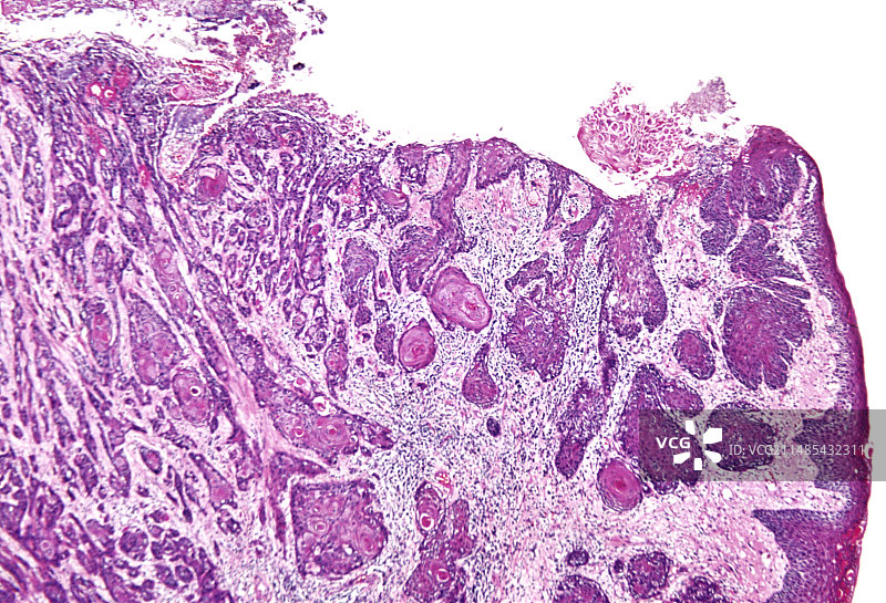 舌癌，光学显微照片图片素材