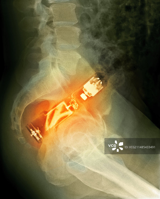 直肠内的电动牙刷X光片图片素材