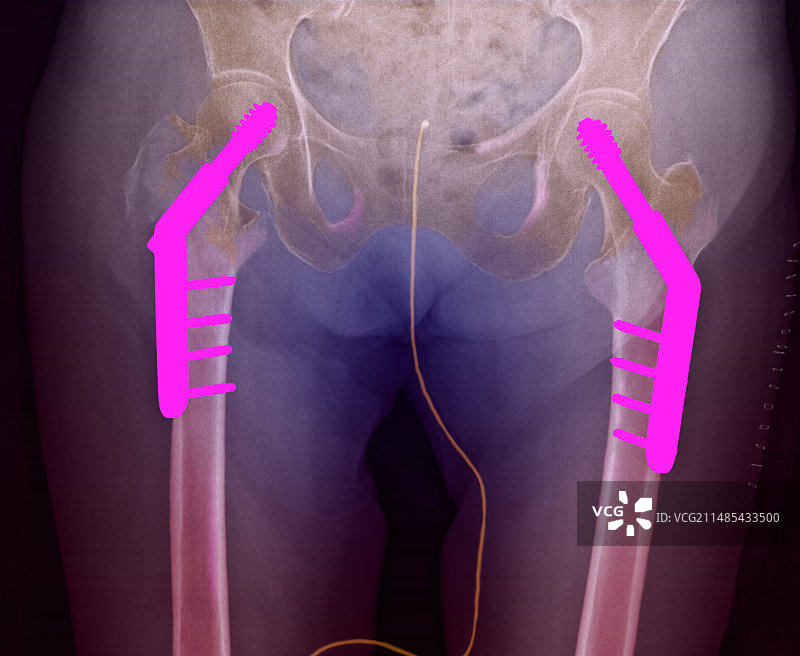 固定双髋骨骨折（图2/2）图片素材