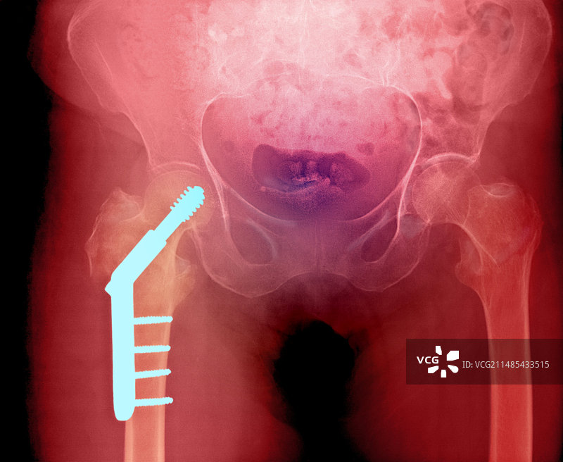 髋部固定和骨折（图1/2）图片素材