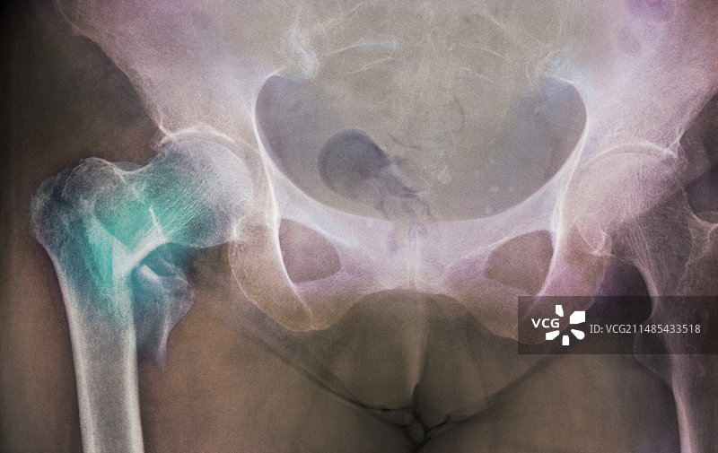 股骨颈骨折X光片图片素材