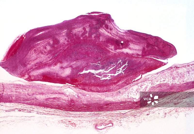膀胱癌显微照片图片素材