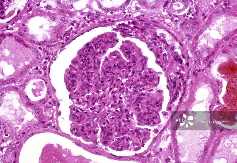 肾小球肾炎显微照片图片素材