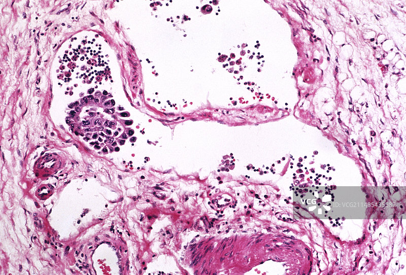 癌性肿瘤的淋巴扩散图片素材