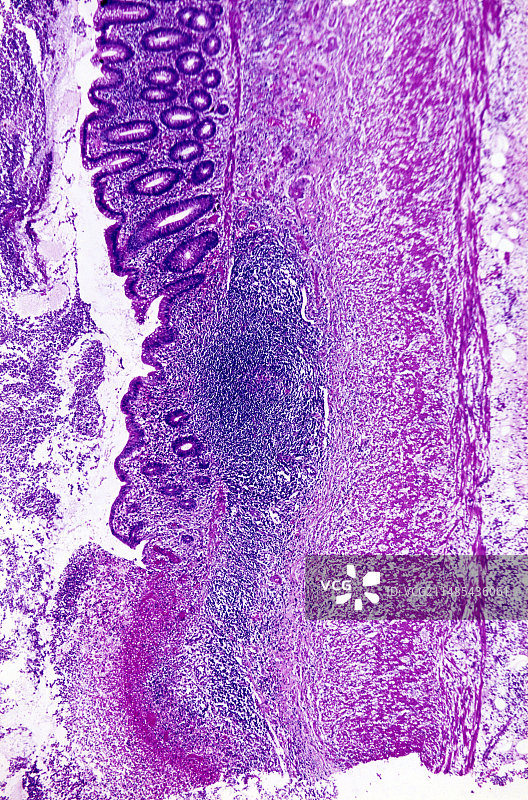 急性阑尾炎，光学显微照片图片素材