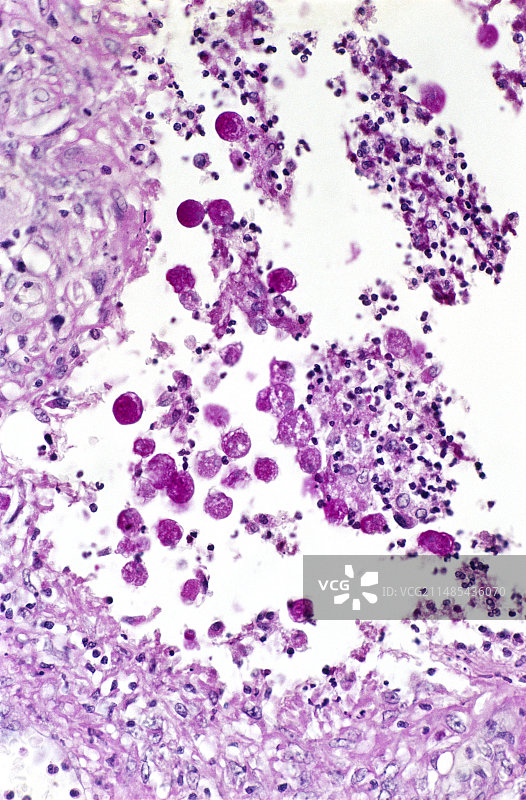 阿米巴结肠炎显微照片图片素材
