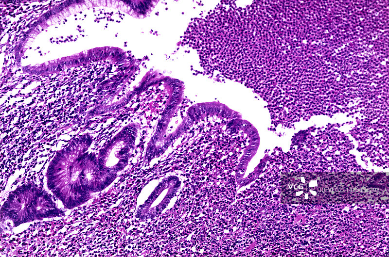 急性阑尾炎，光学显微照片图片素材