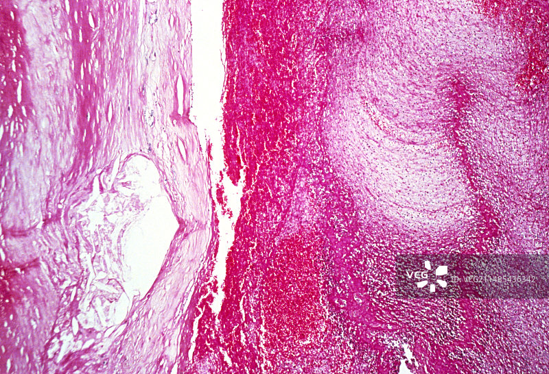 复杂粥瘤浅显显微照片图片素材