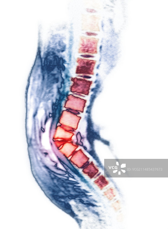 脊柱后凸CT扫描图片素材