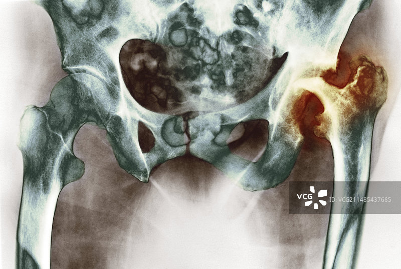 髋关节骨关节炎X光片图片素材