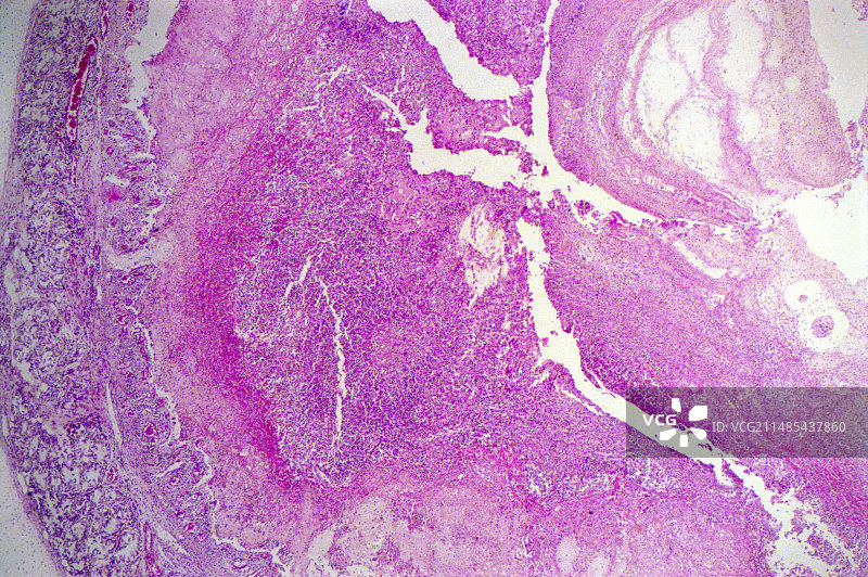 喉癌，光学显微照片图片素材
