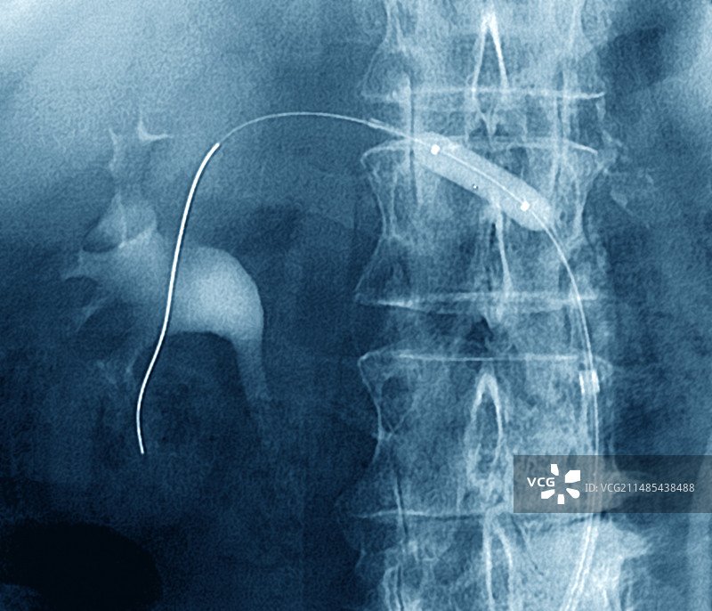 肾血管成形术，X射线图片素材
