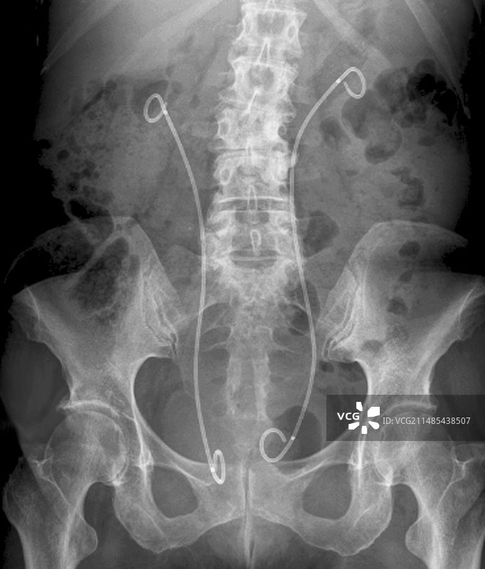 人工肾脏输尿管X光片图片素材