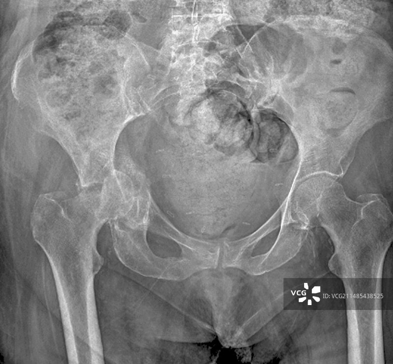 盆骨骨折X光片图片素材