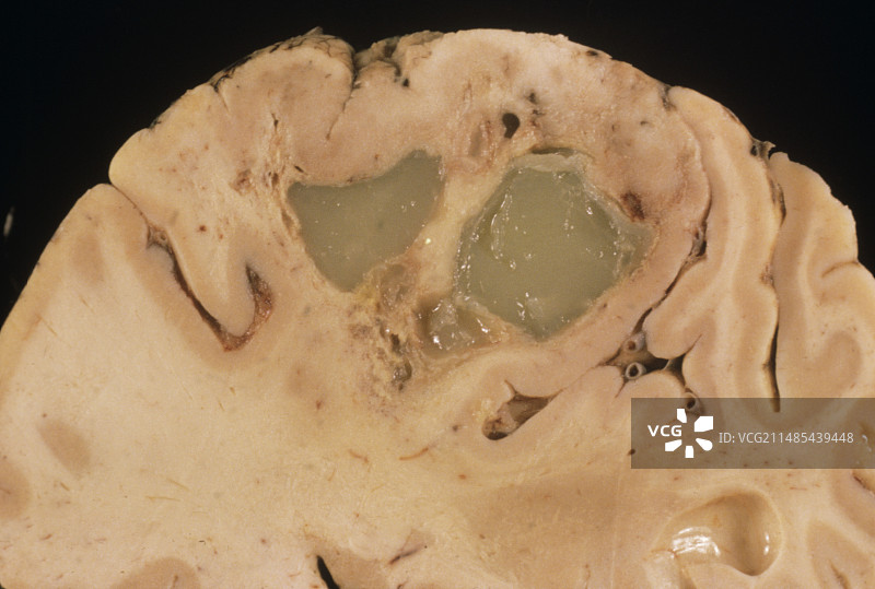 神经胶质瘤脑肿瘤图片素材