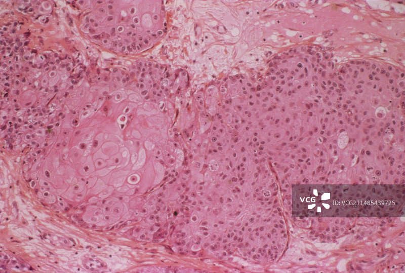 膀胱癌显微照片图片素材