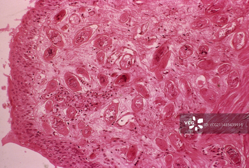 尿路血吸虫病，光学显微照片图片素材