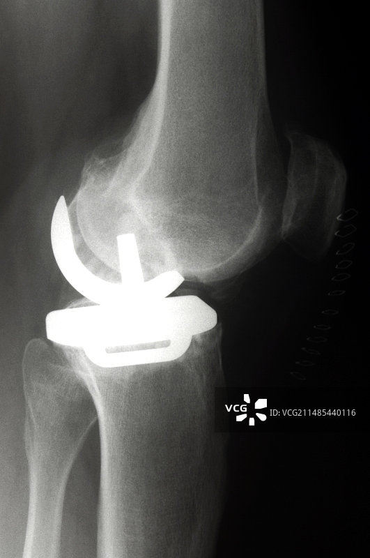 假体膝关节X光片图片素材