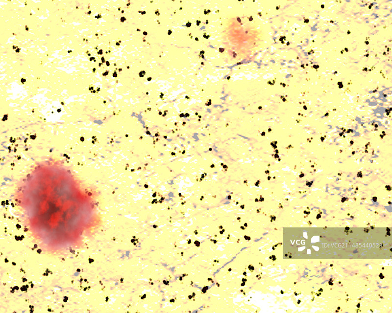克雅氏病变异脑部图片素材
