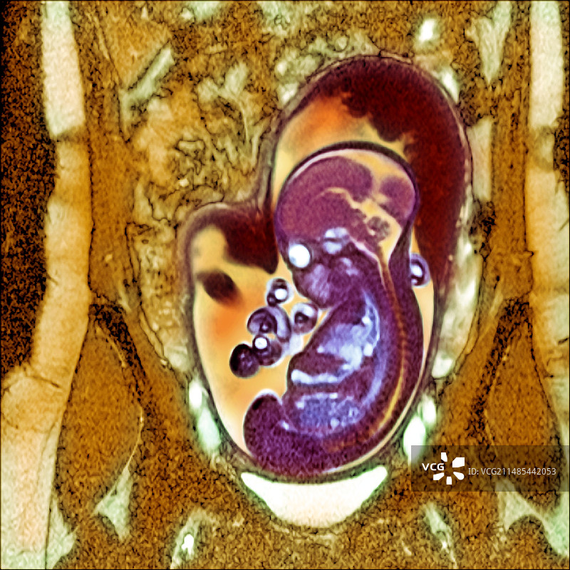 畸形胎儿图片素材