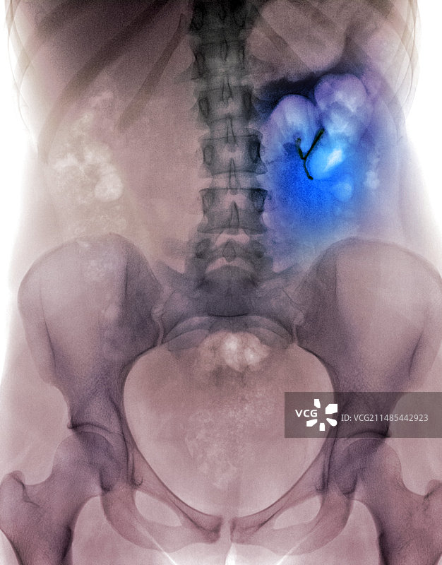 异位IUD避孕具X光片图片素材