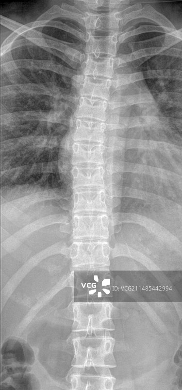 正常的脊柱和胸腔X光片图片素材