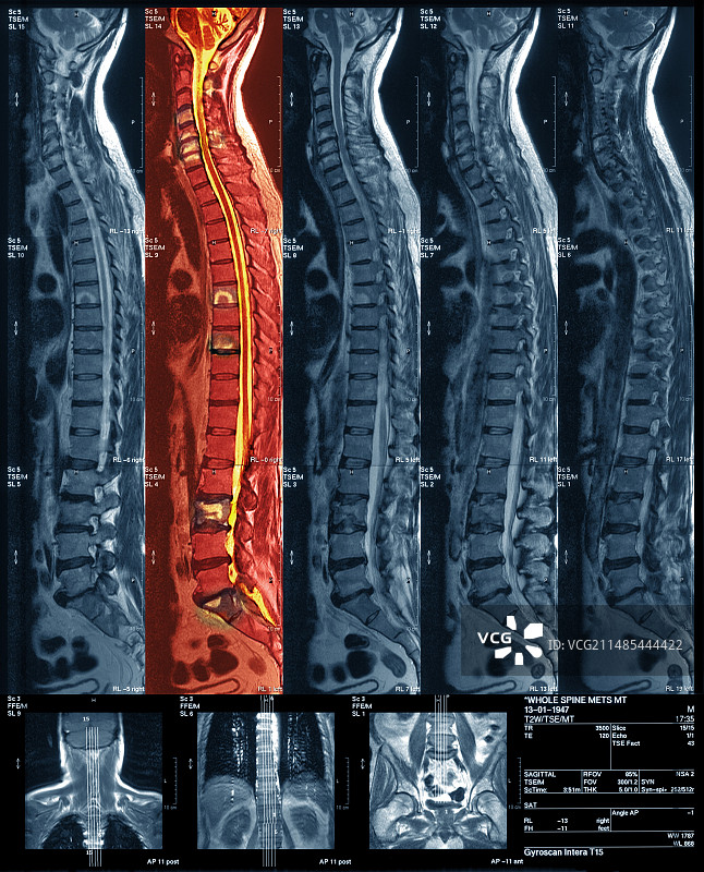骨癌MRI扫描图片素材