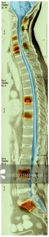 骨癌MRI扫描图片素材