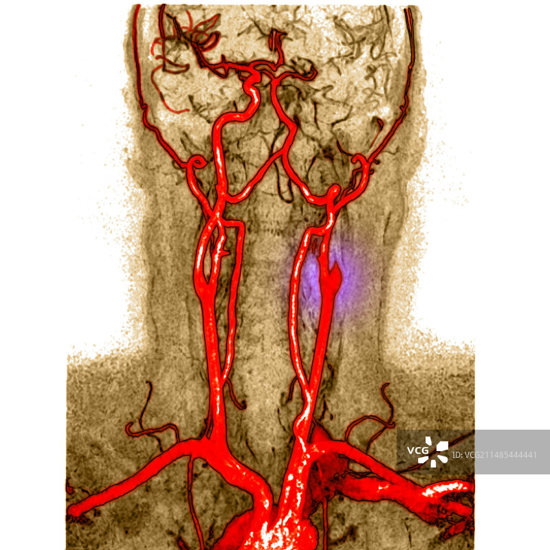 动脉阻塞血管造影图片素材