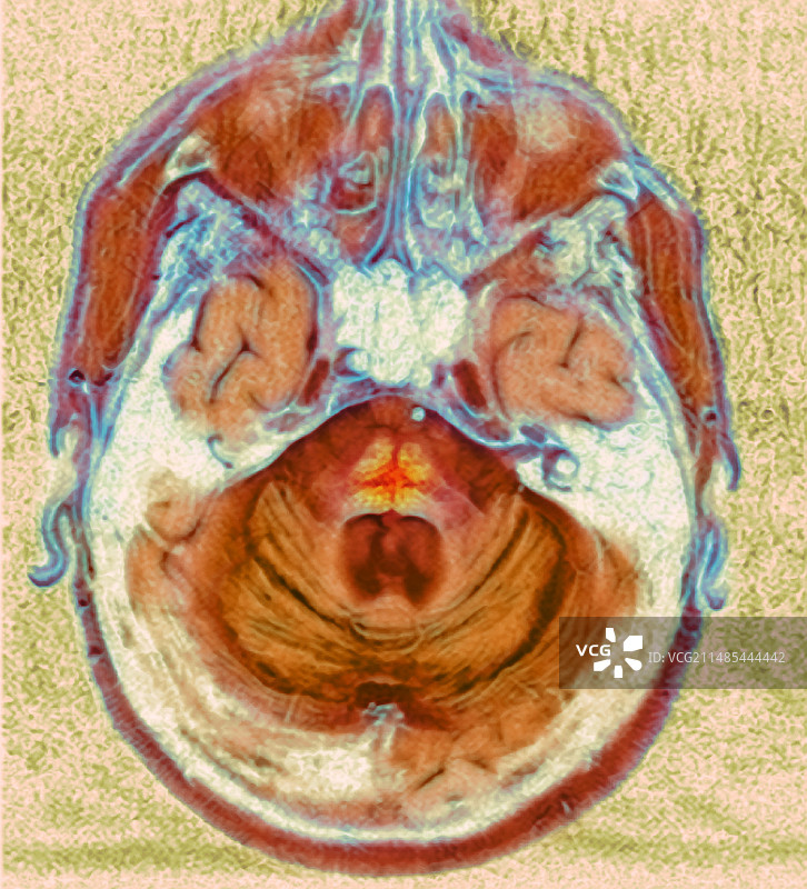 多系统萎缩症核磁共振扫描图片素材
