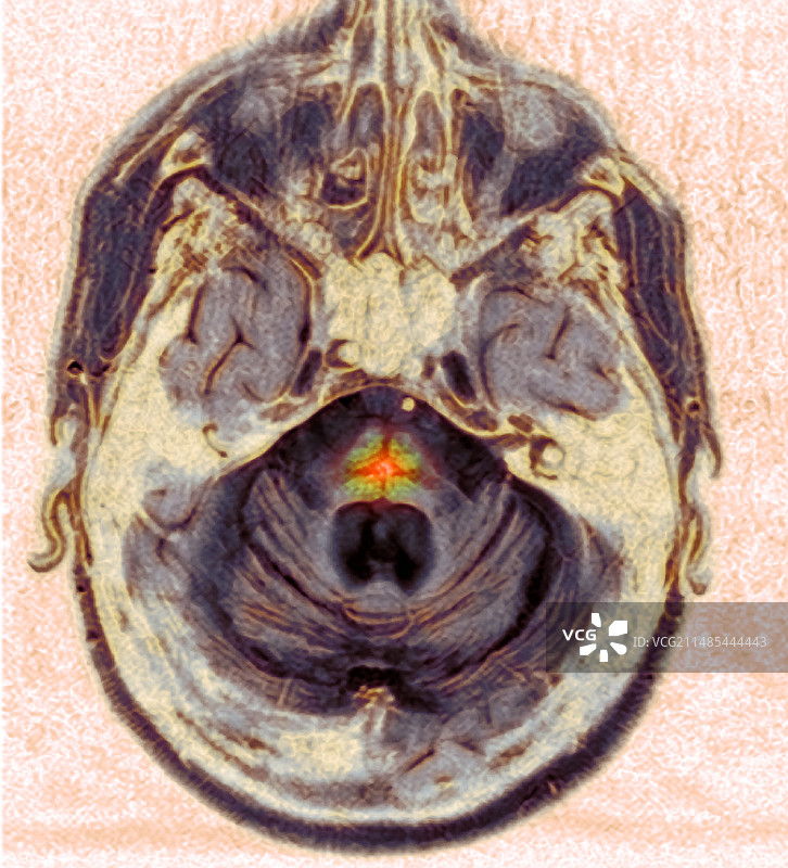 多系统萎缩症核磁共振扫描图片素材