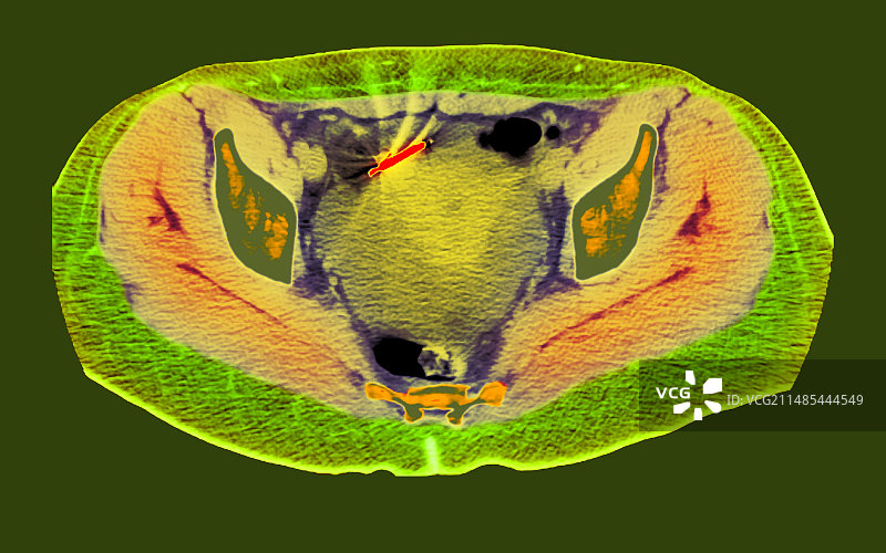 异位宫内节育器避孕具CT扫描图片素材