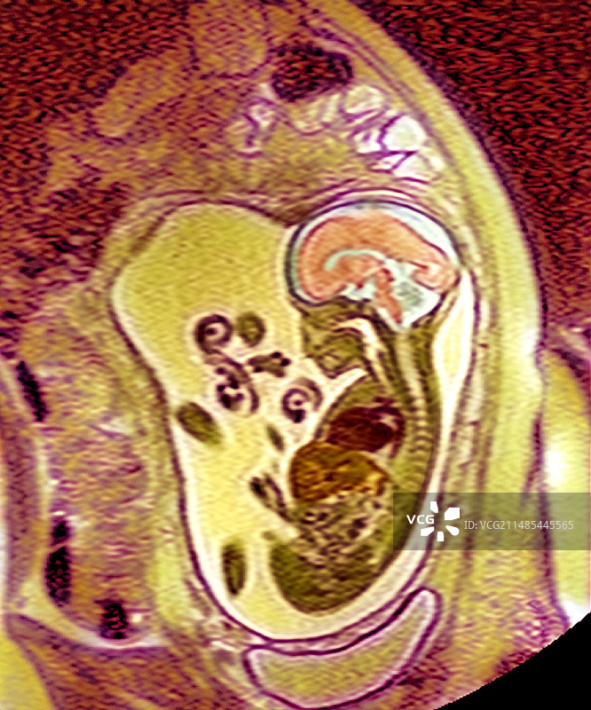 9个月胎儿核磁共振扫描图片素材