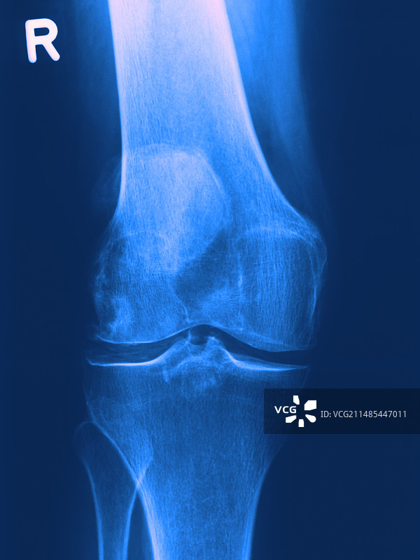 关节炎膝盖图片素材