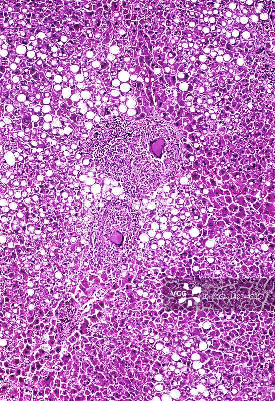 粟粒性结核病显微照片图片素材