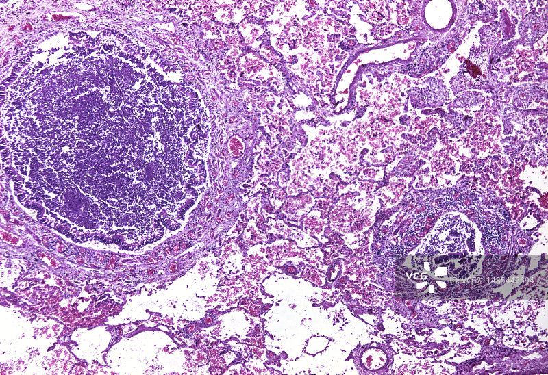 支气管扩张，光学显微照片图片素材