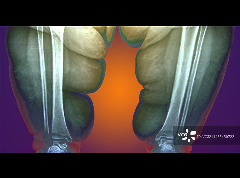 肥胖者的腿部X光片图片素材