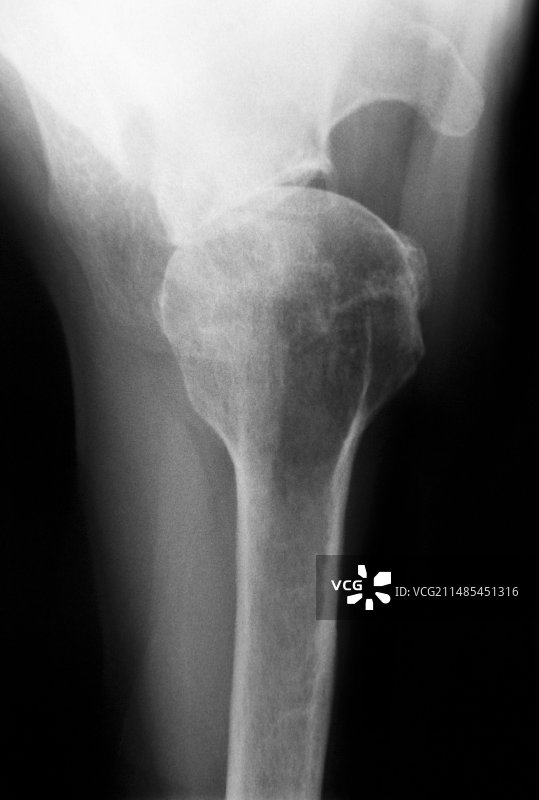 肩部骨关节炎X光片图片素材