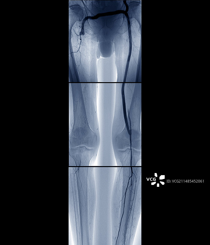 动脉搭桥手术血管造影图片素材