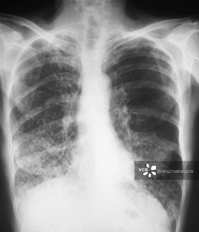 肺结核X光片图片素材