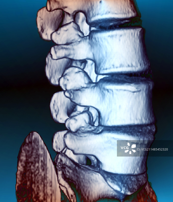 脊柱疾病图片素材