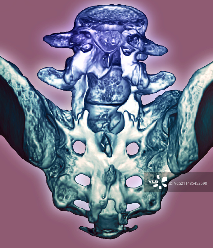 椎间盘滑落图片素材