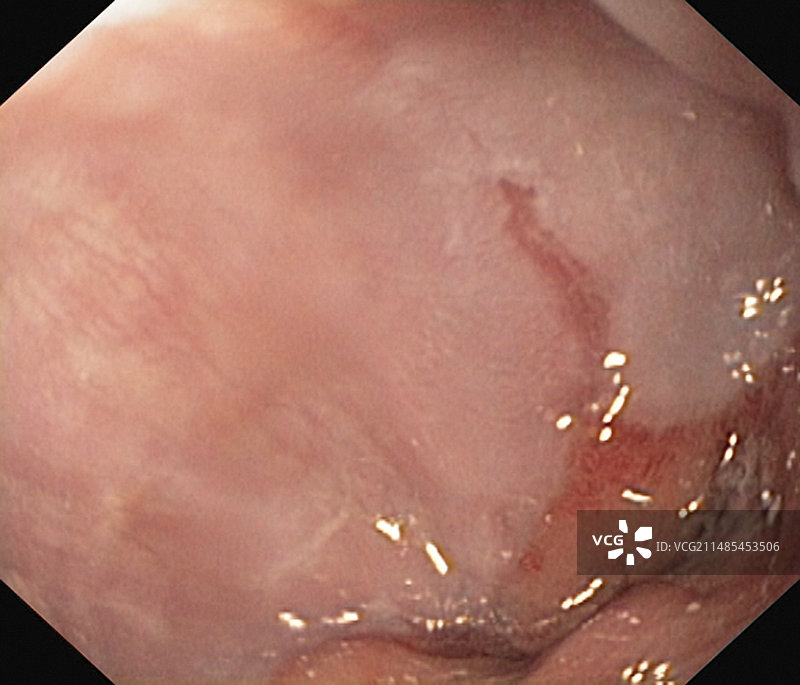 食管炎图片素材