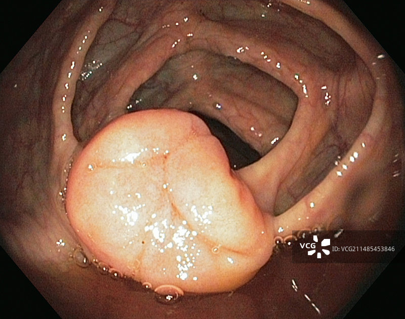健康的迴盲瓣图片素材