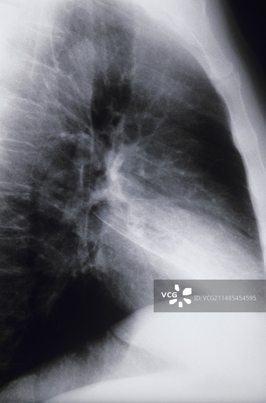 肺炎肺部X光片图片素材
