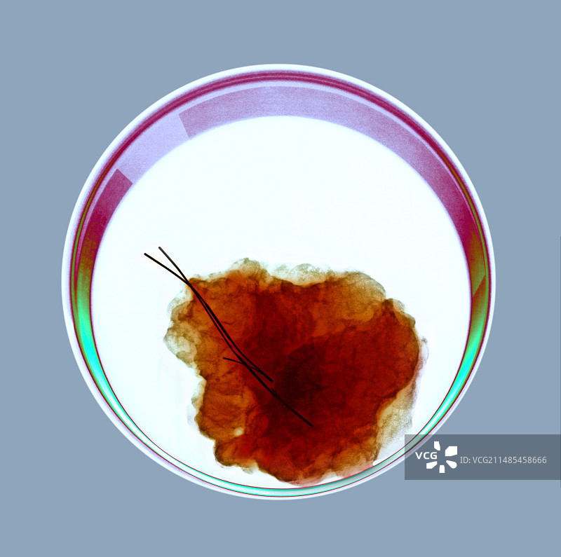 乳腺癌X光片图片素材