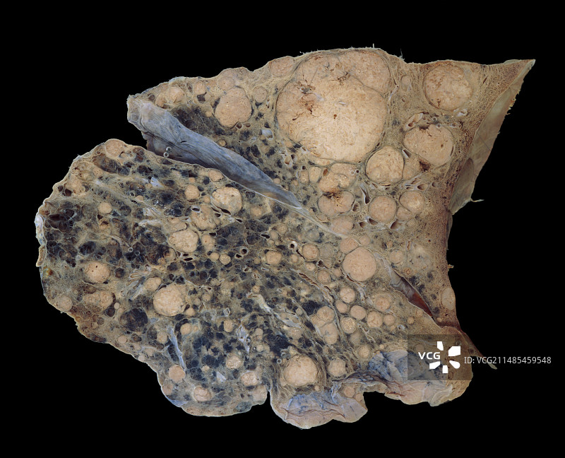 继发性肺癌图片素材