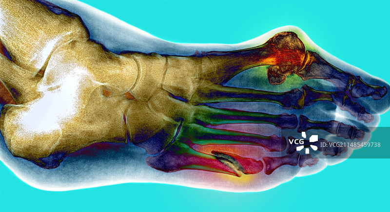 脚部骨折图片素材