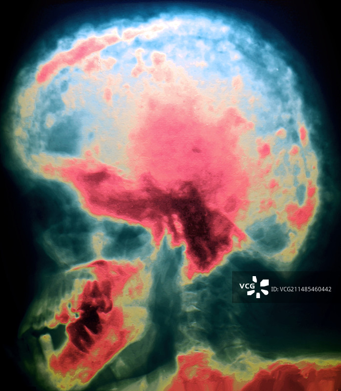 佩吉特病图片素材