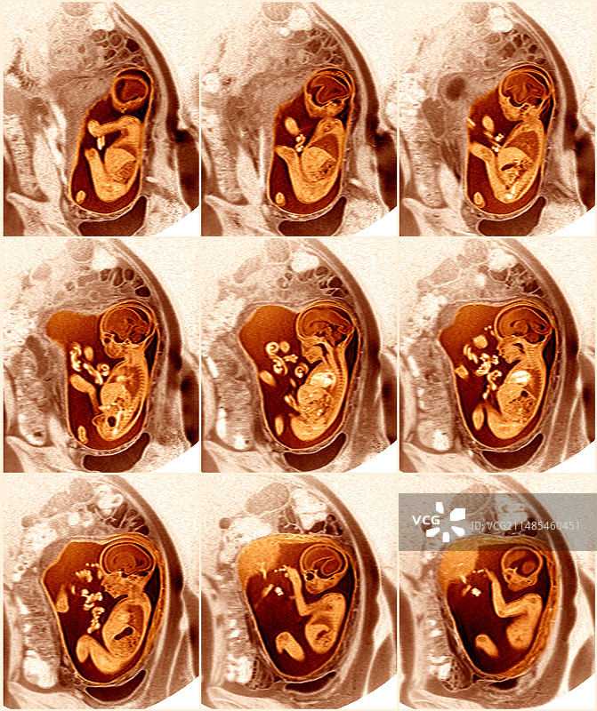 9个月大的胎儿的核磁共振扫描图片素材